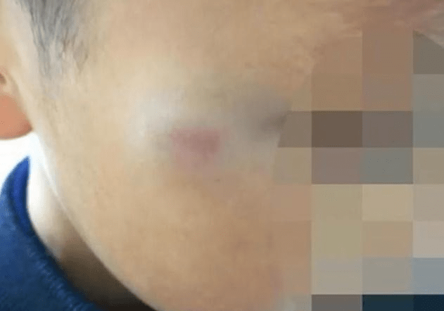 Cậu bé tiểu học bị cô giáo đánh tím mặt: Cô bị đình chỉ ngay lập tức nhưng hành động trước đó của đứa trẻ khiến MXH tranh cãi-1