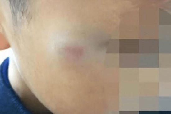 Cậu bé tiểu học bị cô giáo đánh tím mặt: Cô bị đình chỉ ngay lập tức nhưng hành động trước đó của đứa trẻ khiến MXH tranh cãi