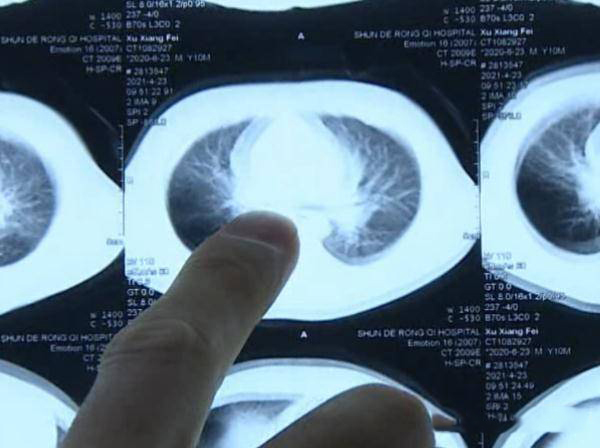 Đưa con đi khám vì đang ăn cháo bỗng ho liên tục, bà mẹ sợ tái mặt khi nhìn vào phim chụp X-quang-2