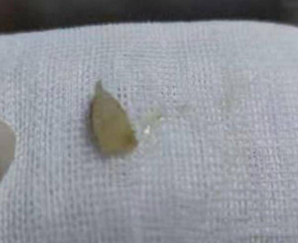 Đưa con đi khám vì đang ăn cháo bỗng ho liên tục, bà mẹ sợ tái mặt khi nhìn vào phim chụp X-quang-3