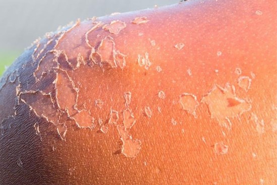 Bỏng da do cháy nắng xử lý thế nào?