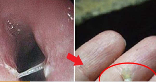 Mẹo chữa hóc xương cá chỉ trong 1 nốt nhạc mà không cần đi gặp bác sĩ-1