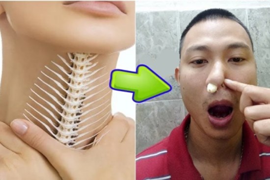Mẹo chữa hóc xương cá chỉ trong '1 nốt nhạc' mà không cần đi gặp bác sĩ