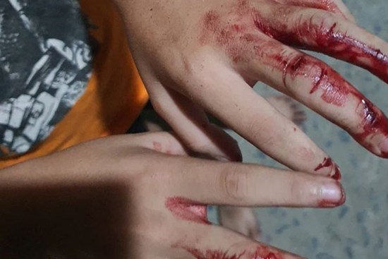 TP.HCM: Cha đánh con nát tay, bắt đi bán vé số