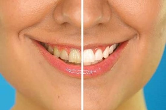 8 cách làm trắng răng tự nhiên đơn giản ngay tại nhà