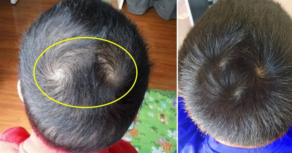 Số lượng xoáy tóc trên đầu trẻ tượng trưng cho điều gì? Trẻ có nhiều xoáy thường thông mình, nhiều tài lẻ có đúng như mọi người thường nói?-1