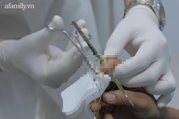 Cô gái 29 tuổi nhập viện cấp cứu với cây kim nhọn khổng lồ đâm xuyên ngón tay, đau đớn tột độ-2