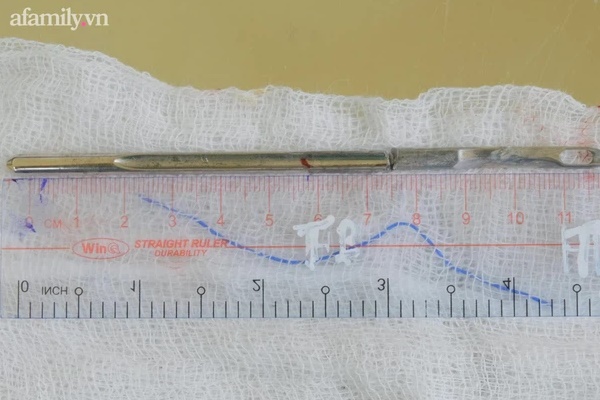 Cô gái 29 tuổi nhập viện cấp cứu với cây kim nhọn khổng lồ đâm xuyên ngón tay, đau đớn tột độ-3