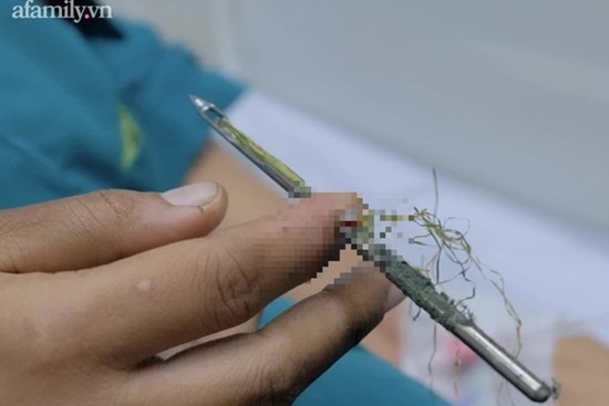 Cô gái 29 tuổi nhập viện cấp cứu với cây kim nhọn 