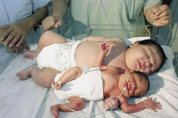 Uống thuốc phá thai lúc bầu 18 tuần, mẹ bất ngờ khi thai vẫn còn sống, nhìn con chào đời mà tột cùng hối hận-5