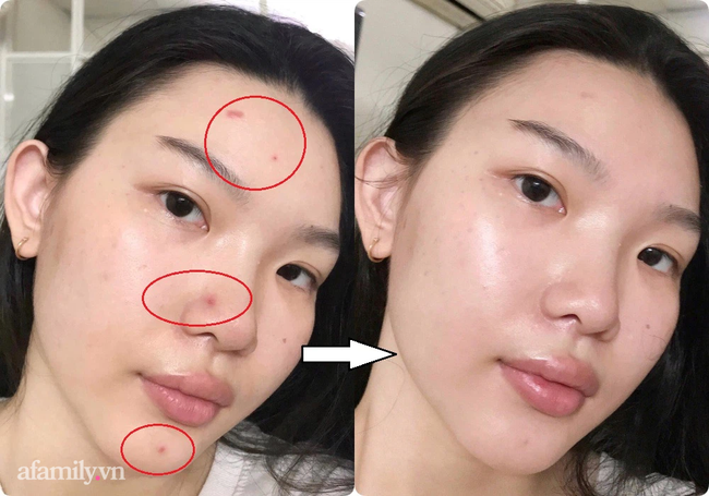 2 lọ serum giúp cô nàng da nhờn dính đỡ hẳn mụn và vết thâm, dùng trong mùa hè cực kỳ yên tâm-1