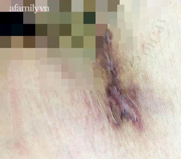 Quan hệ tình dục với nhiều bạn tình, nam thanh niên 28 tuổi nhiễm cùng lúc giang mai và căn bệnh hột xoài hiếm gặp-3