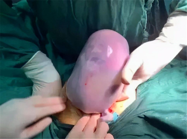 Vừa nhìn con chào đời, ông bố sợ tái mặt không dám bế nhưng bác sĩ liền chúc mừng điều may mắn hiếm có-1