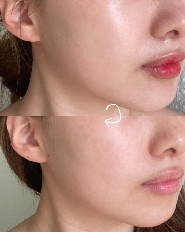 Bác sĩ hướng dẫn 4 cách làm sạch tận cùng lỗ chân lông trong mùa hè dễ bí da, lên mụn ẩn-1