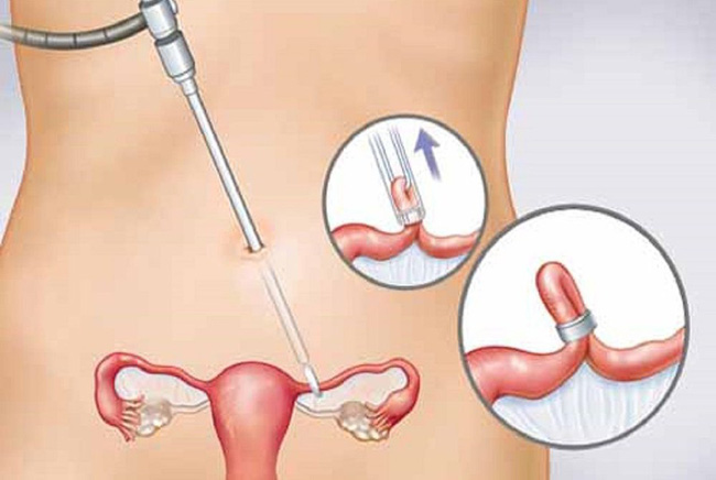 Triệt sản được 10 tháng, mẹ Hà Nội chỉ ra loạt ưu, nhược điểm và khẳng định chắc nịch: Biết trước đã làm sớm hơn-1