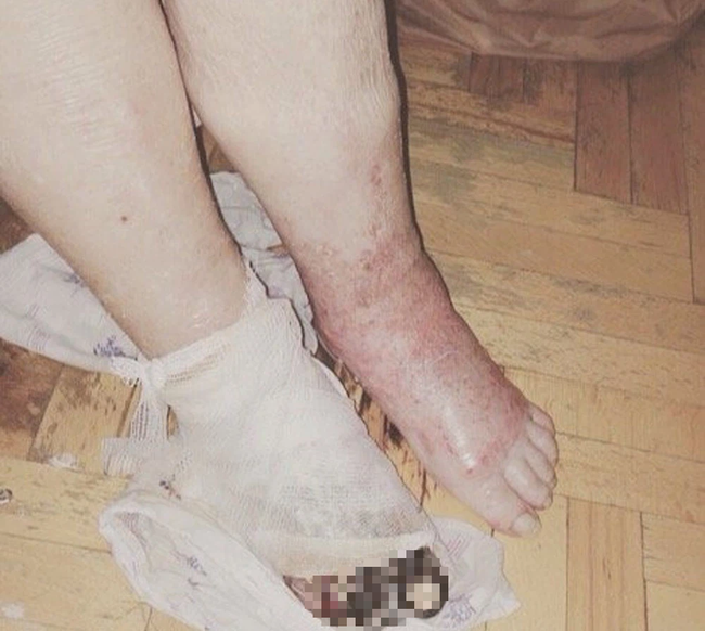 Cụ ông bị đau chân đến phòng khám tư kiểm tra và được chỉ định cưa chân, phẫu thuật xong bác sĩ cúi rạp xin lỗi vì lý do trời ơi đất hỡi-2