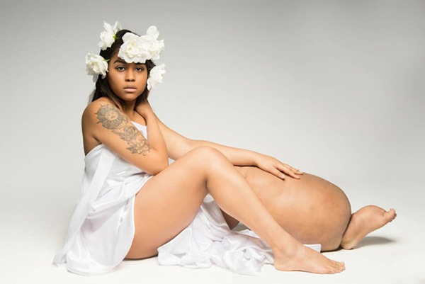 Cô gái mắc bệnh lạ khiến 1 chân không ngừng phù ra, bị trêu chọc là quái vật” nhưng cơ thể và cuộc sống hiện tại khiến ai cũng thán phục-4