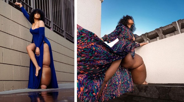 Cô gái mắc bệnh lạ khiến 1 chân không ngừng phù ra, bị trêu chọc là quái vật” nhưng cơ thể và cuộc sống hiện tại khiến ai cũng thán phục-5