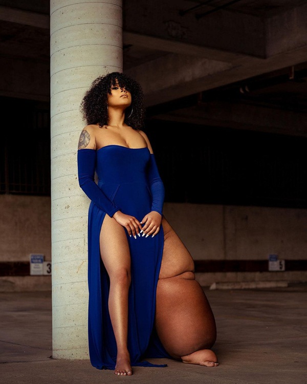 Cô gái mắc bệnh lạ khiến 1 chân không ngừng phù ra, bị trêu chọc là quái vật” nhưng cơ thể và cuộc sống hiện tại khiến ai cũng thán phục-7