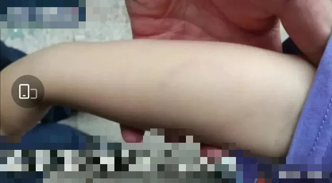 Con trai bị cắn bầm tay vì cách dạy lạ đời của giáo viên, mẹ hổ đến trường đòi công bằng không ngờ đấm gãy xương sườn cô giáo-1
