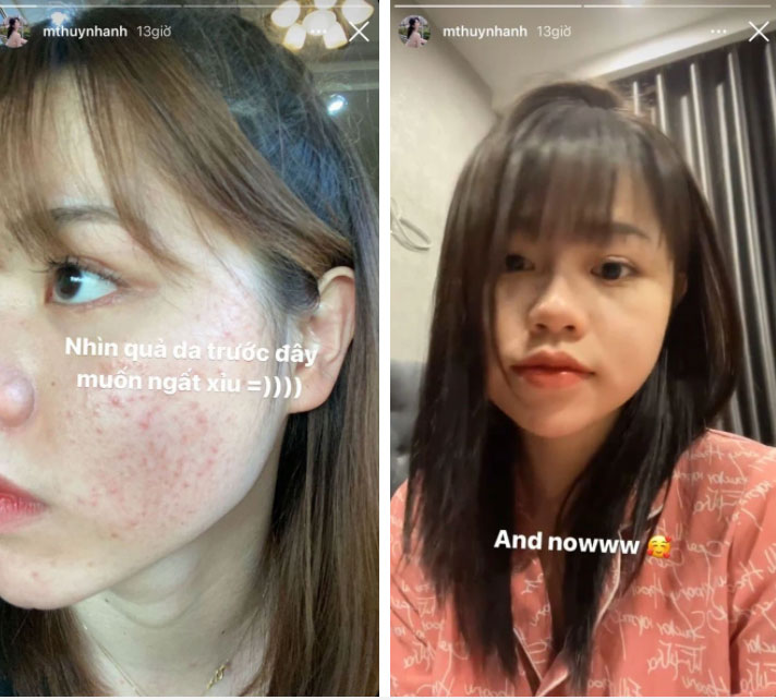 Bồ cũ Quang Hải công khai ảnh da đầy mụn trước đây, netizen sửng sốt vì thay đổi ngỡ ngàng-2
