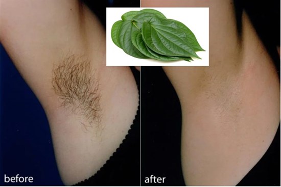 5 cách triệt lông tại nhà bằng nguyên liệu tự nhiên, vừa an toàn vừa hiệu quả