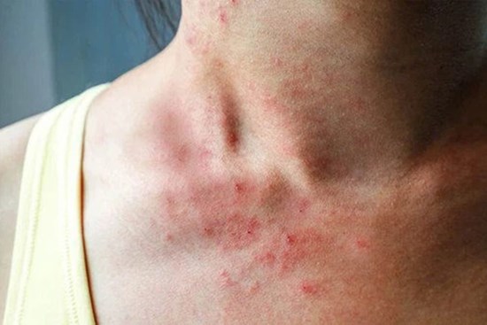20% bệnh nhân ung thư có triệu chứng ngứa: Nếu 3 vị trí này trên cơ thể cảm thấy ngứa liên tục, bạn nên đi khám khẩn cấp