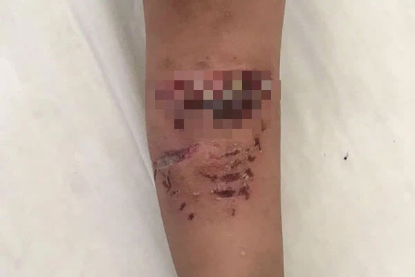 Chó Pitbull lao tới cắn bé 2 tuổi ở Khánh Hòa: Người cha thọc tay vào miệng con chó, cạy răng để cứu con-1