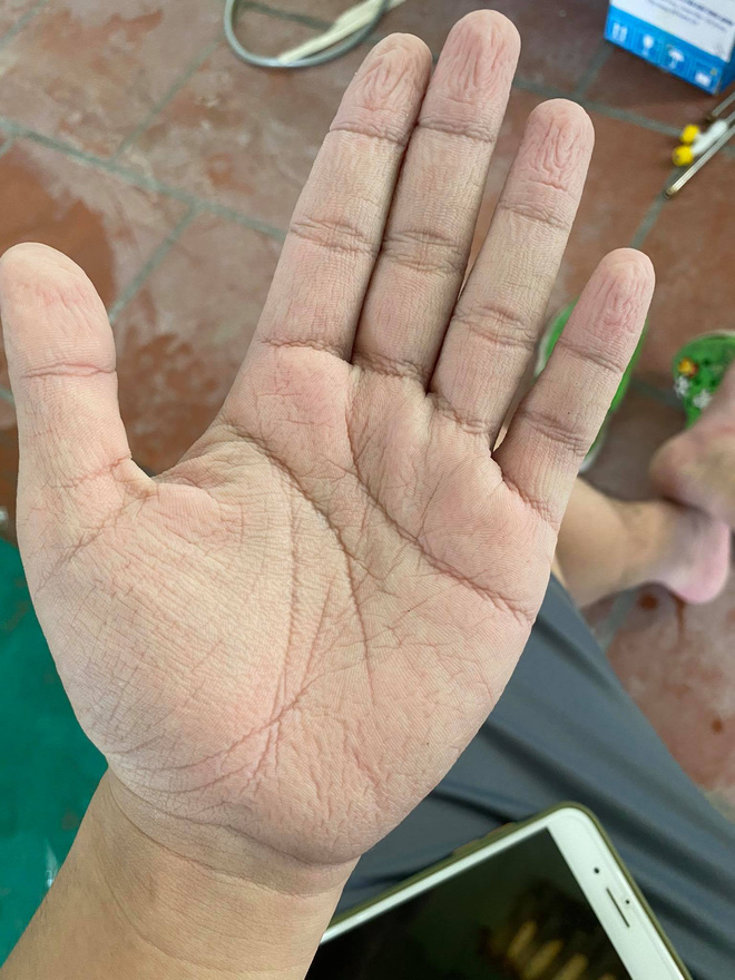 Nam sinh 20 tuổi ngất xỉu khi lấy mẫu xét nghiệm trong thời tiết 40 độ ở Bắc Giang: Mình ngồi xuống định nghỉ một lúc thì sau đó không biết gì nữa...-5