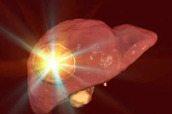 Nữ giáo viên 29 tuổi qua đời vì ung thư gan, bác sĩ nói: Tiếc là đã duy trì 2 thói quen này quá lâu-3