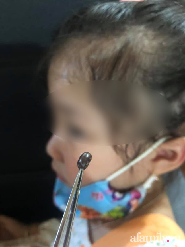 Rùng mình xem cảnh gắp dị vật to chà bá, nảy mầm tươi tốt trong lỗ tai bé trai-1