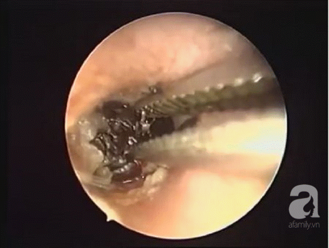 Rùng mình xem cảnh gắp dị vật to chà bá, nảy mầm tươi tốt trong lỗ tai bé trai-3