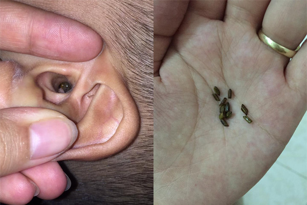 Rùng mình xem cảnh gắp dị vật to chà bá, nảy mầm tươi tốt trong lỗ tai bé trai-5