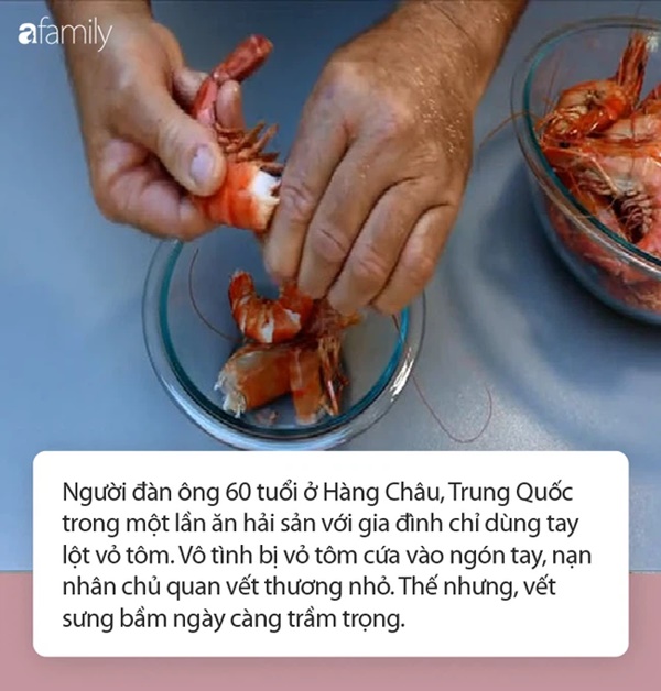 Chỉ làm duy nhất việc này trước khi ăn tôm và người đàn ông tử vong: Chuyên gia cảnh báo nguy cơ khi ăn hải sản có vỏ!-2