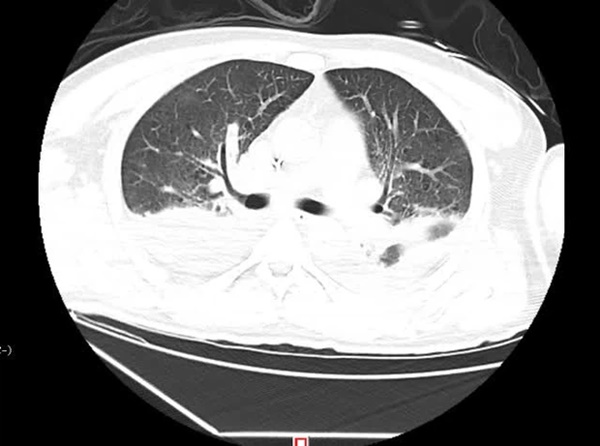 Người đàn ông suýt chết vì suy đa tạng, viêm phổi, bác sĩ chỉ ra nguyên nhân là chiếc điều hòa trong xe hơi 2 tháng không sử dụng-4