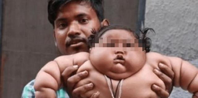 Cậu bé 1 tuổi nặng hơn 22kg, trung bình một ngày ăn 15 bữa, cuộc sống 6 năm sau khiến ai nấy giật mình-1