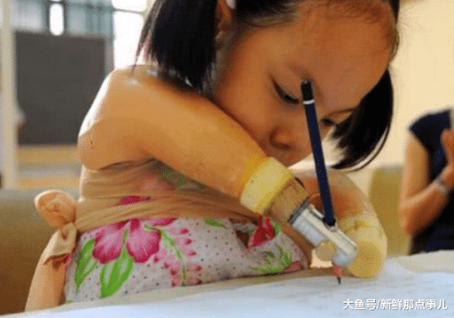 Bác sĩ chẩn đoán bào thai hải cẩu”, khuyên nên bỏ nhưng người mẹ kiên quyết sinh con, đứa trẻ sau này khiến ai cũng bất ngờ-5