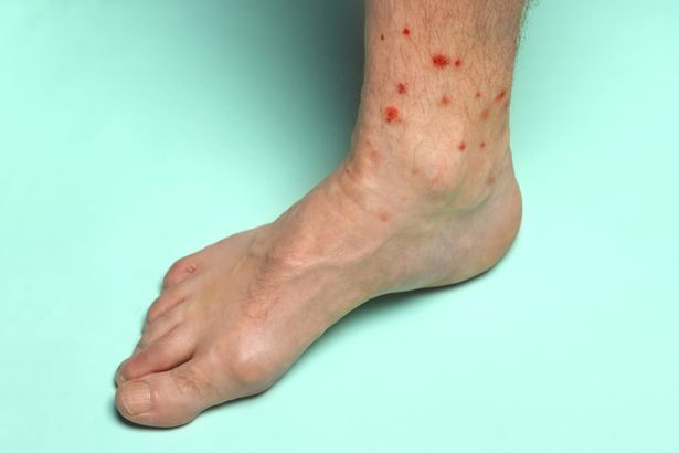 Đây là căn bệnh ung thư giết chết 2.500 người Anh mỗi năm, 6 dấu hiệu cảnh báo rất ít ai ngờ đến-2