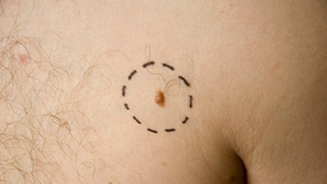 Đây là căn bệnh ung thư giết chết 2.500 người Anh mỗi năm, 6 dấu hiệu cảnh báo rất ít ai ngờ đến-4