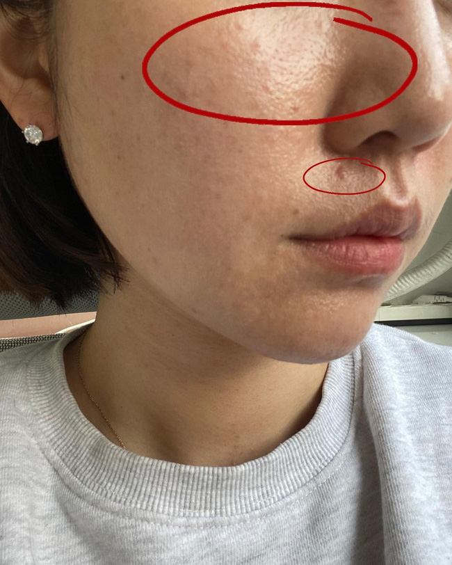 Combo da dầu mụn kinh khủng khiếp: Bước làm sạch da nên dùng gì và tránh gì?-1