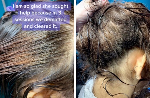 Mang mái tóc bẩn thỉu, lúc nhúc hàng ngàn con chấy đến phòng khám, cô gái khiến chuyên gia thảng thốt vì sốc và kết quả đáng kinh ngạc-3