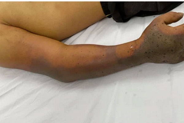 Tự chữa rắn cắn khiến nam thanh niên 27 tuổi hoại tử bàn tay-1