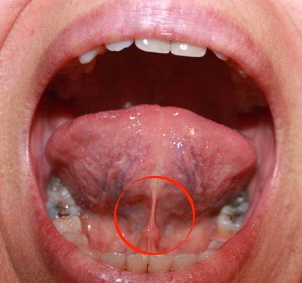 Tại sao việc đầu tiên các đồng đội của Christian Eriksen làm là ngăn không cho anh nuốt lưỡi? Nuốt lưỡi trong bóng đá nguy hiểm thế nào?-1