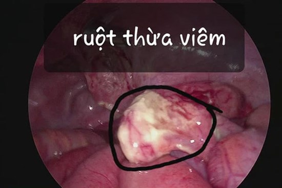 Bé gái 8 tuổi suýt tử vong vì gia đình sợ COVID nên không đưa con đi khám