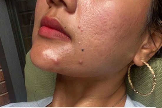 Nếu bạn cứ làm 4 bước skin care này thì lỗ chân lông trên da sẽ ngày càng to ngoác