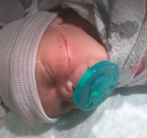Bé gái vừa chào đời đã phải khâu 13 mũi vì bị bác sĩ rạch vào mặt trong lúc mổ đẻ-1