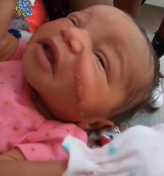 Bé gái vừa chào đời đã phải khâu 13 mũi vì bị bác sĩ rạch vào mặt trong lúc mổ đẻ-2