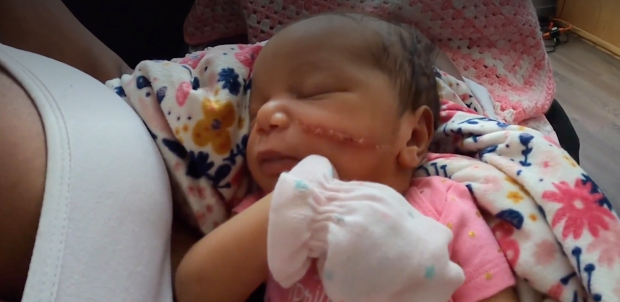 Bé gái vừa chào đời đã phải khâu 13 mũi vì bị bác sĩ rạch vào mặt trong lúc mổ đẻ-3