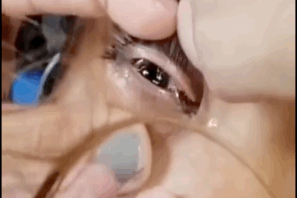 Kinh hãi: Thanh niên 18 tuổi khó thở đi khám bệnh, phát hiện con đỉa dài 6cm sống trong mũi-2