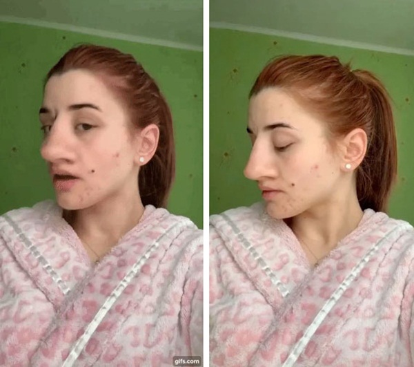 Cô gái chia sẻ hình ảnh trước và sau khi sửa mũi thu hút 13 triệu lượt xem vì lột xác ảo diệu, tưởng được khen xinh hoá ra gây tranh cãi lớn-1